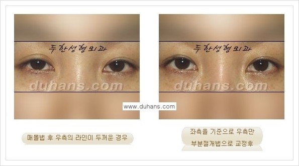 [두한성형외과 경쟁력 쌍꺼풀 재수술, 극한 재수술] - [비대칭(짝짝이) 쌍꺼풀 라인 교정 안내] 관련 이미지 5