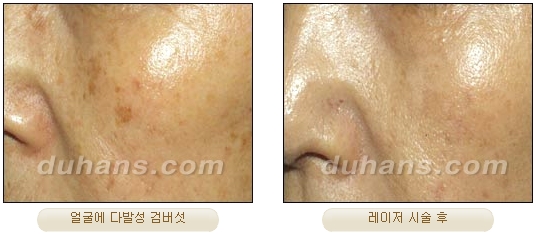 Duhan Plastic Surgery Laser Treatment - Mole Removal, Spot Removal, Melasma, Blemishes, Hyperpigmentation, Skin Tone Improvement, Elasticity Improvement, Skin Texture Improvement image 36
