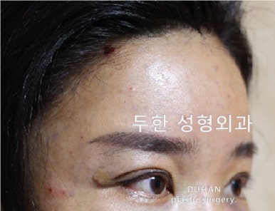 [Duhan Plastic Surgery Forehead Surgery] - [Forehead Fat Grafting for Forehead Surgery] image 17