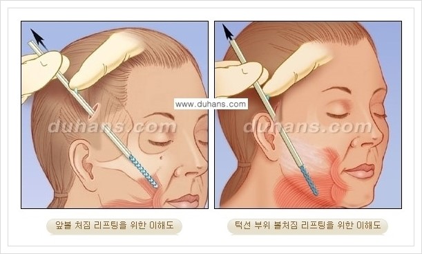 [두한성형외과 경쟁력 주름성형] - [주름제거 방법 안내] 관련 이미지 6