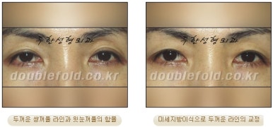 [두한성형외과 쌍커풀수술] - [쌍꺼풀지방이식] 관련 이미지 17