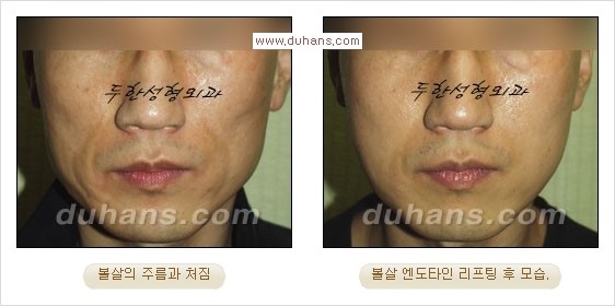 [두한성형외과 경쟁력 주름성형] - [눈썹거상, 앞볼처짐 개선의 엔도타인 리프팅] 관련 이미지 15