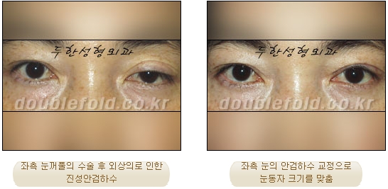 [Duhan Plastic Surgery Double Eyelid Revision Surgery] - [Ptosis, sausage eyelids] image 6