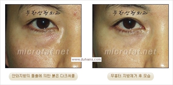[두한성형외과 경쟁력 눈밑성형] - [과도한 눈밑지방제거의 부작용 후 눈밑지방재배치] 관련 이미지 15