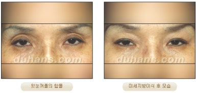 [Duhan Plastic Surgery Micro Fat Grafting] - [Upper Eyelids] image 10