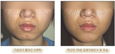 [Duhan Plastic Surgery Micro Fat Grafting] - [Receded Chin, Small Chin, Cleft Chin, Chin Line Asymmetry Correction] image 10