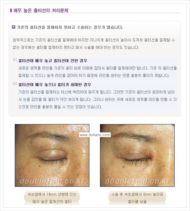[두한성형외과 경쟁력 쌍꺼풀 재수술(극한 재수술)] - [쌍꺼풀 재수술에서 극복해야 할 여러 가지 상황과 문제점들 안내] 관련 이미지 1