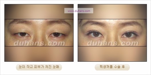 [두한성형외과 경쟁력 눈성형] - [자연스럽고 아름다운 눈매를 만드는 여러 가지 눈성형 방법] 관련 이미지 15