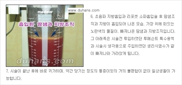 [두한성형외과 성형 FOCUS 지방흡입] - [액취증 - 다한증 초음파 컷터 지방흡입 ③] 관련 이미지 13