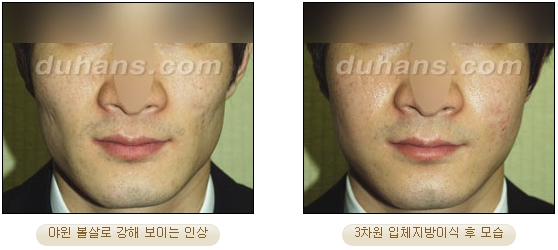 [두한성형외과 얼굴자가지방이식] - [볼살, 이마, 측두부] 관련 이미지 34
