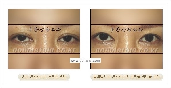 [두한성형외과 경쟁력 쌍꺼풀 재수술, 극한 재수술] - [안검하수(졸린눈매) 교정 방법 안내] 관련 이미지 8