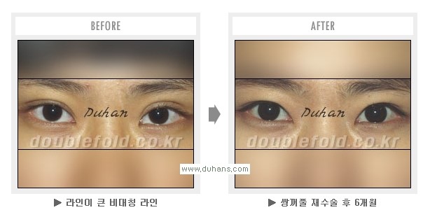 [두한성형외과 Dr. 컬럼] - [쌍꺼풀 재수술(눈 재수술)의 목적] 관련 이미지 8