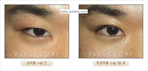 [두한성형외과 경쟁력 눈성형] - [퀵쌍꺼풀(부분절개법) 수술 안내] 관련 이미지 11