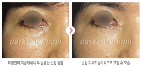 [두한성형외과 눈밑성형] - [다크서클 치료 실패] 관련 이미지 5