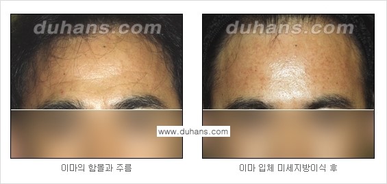[두한성형외과 경쟁력 주름성형] - [지방이식을 이용한 이마주름, 미간주름 제거] 관련 이미지 10