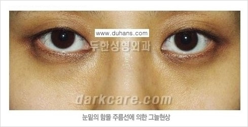 [두한성형외과 경쟁력 눈밑성형] - [눈밑 다크써클 원인과 눈밑 다크써클 치료 방법 안내] 관련 이미지 5