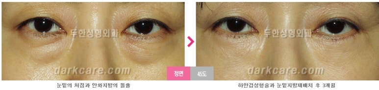 [두한성형외과 다크서클] - [다크서클 전후사진 검증] 관련 이미지 129