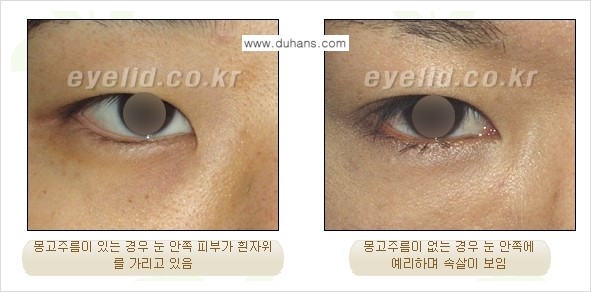 [두한성형외과 눈성형 FOCUS] - [몽고주름 제거(앞트임 제거) 수술 ③] 관련 이미지 2