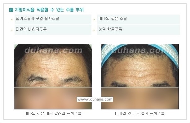 ​[두한성형외과 경쟁력 주름성형] - [주름교정을 위한 미세지방이식 안내 1.] 관련 이미지 2