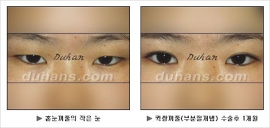 Best Place for Double Eyelid Revision Surgery, Duhan Plastic Surgery - Partial Incision Eye Revision Surgery image 17