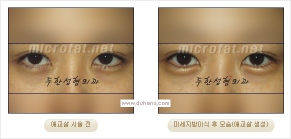 [두한성형외과 경쟁력 눈밑성형] - [타 병원 필러 애교살 시술 부작용을 미세지방이식으로 교정] 관련 이미지 21