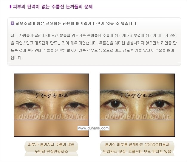 [두한성형외과 경쟁력 있는 쌍꺼풀 재수술] - [극복해야 할 극한의 상황과 문제들] 관련 이미지 9