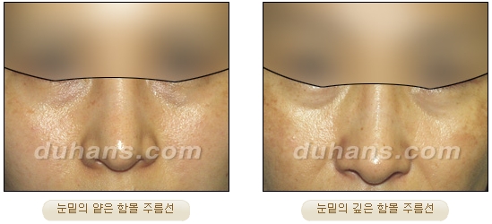 [Duhan Plastic Surgery Wrinkle Improvement] - [Wrinkle Lifting] image 6