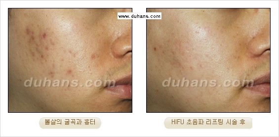 [두한성형외과 경쟁력 주름성형] - [주름제거를 위한 리프팅] 관련 이미지 43