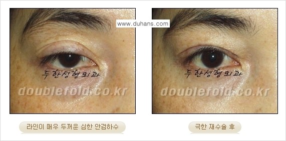 [두한성형외과 경쟁력 눈성형] - [극한의 상태에서 쌍꺼풀재수술(눈재수술) 안내] 관련 이미지 11