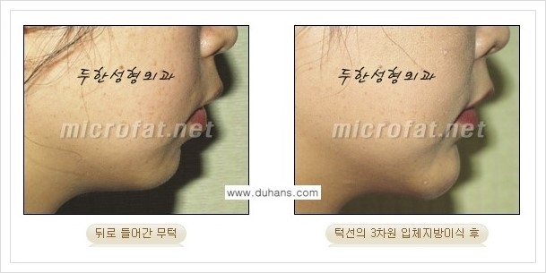 [두한성형외과 경쟁력 안면윤곽 교정] - [미세지방이식으로 무턱, 작은턱, 오목턱, 턱선의 비대칭 교정 안내] 관련 이미지 6