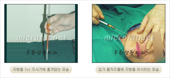 [두한성형외과 경쟁력 안티에이징 동안성형] - [주름이 깊은 푹~ 꺼진 입가 팔자주름 안녕!] 관련 이미지 13