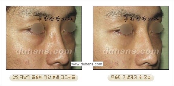 [두한성형외과 젊은 눈매 안검성형] - [눈밑 지방제거의 수술 전후 안내 ②] 관련 이미지 19