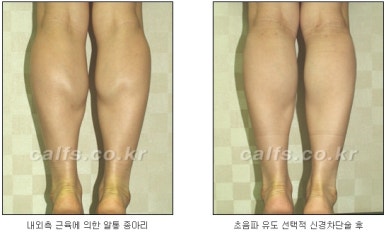 ​[두한성형외과 종아리수술] - [나에게 맞는 종아리성형방법] 관련 이미지 7
