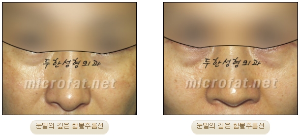 [두한성형외과 지방이식] - [다크써클, 눈​밑주름] 관련 이미지 4