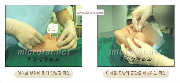 [두한성형외과 경쟁력 미세지방이식] - [타 병원의 지방이식 부작용 교정 - 정교한 마이크로 지방이식, 흡입 안내] 관련 이미지 28