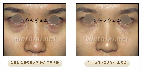 [두한성형외과 경쟁력 지방이식 리더] - [Col-fat(콜펫)지방이식, 3차원 입체지방이식, 2차원 평면지방이식] 관련 이미지 61