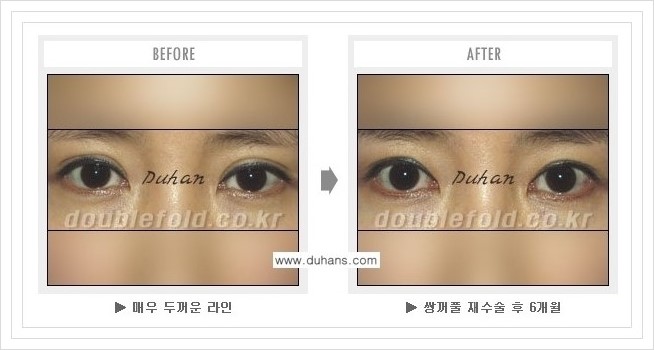 [두한성형외과 경쟁력 쌍꺼풀 재수술, 극한 재수술] - [여러번의 재수술로 인해 흉살이 두터운 경우 교정 방법 안내] 관련 이미지 6