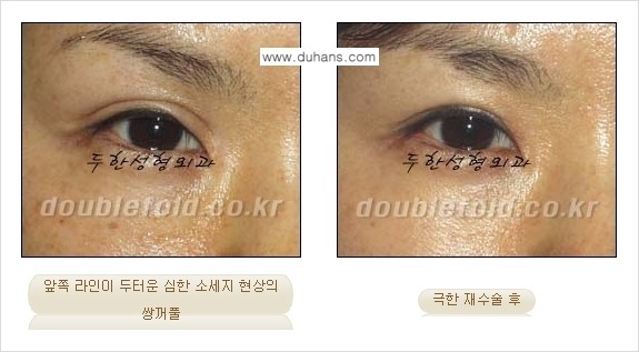 [두한성형외과 경쟁력 눈성형] - [극한의 상태에서 쌍꺼풀재수술(눈재수술) 안내] 관련 이미지 4