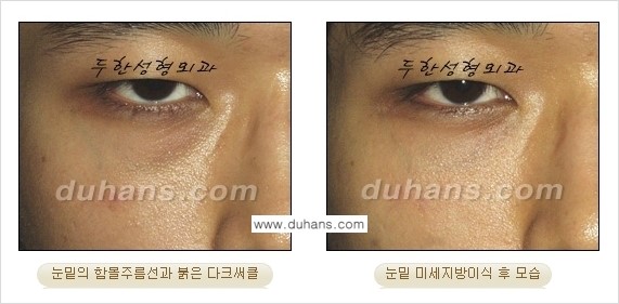 [두한성형외과 상큼하고 환한 눈매완성] - [눈밑 미세지방이식 ②] 관련 이미지 17