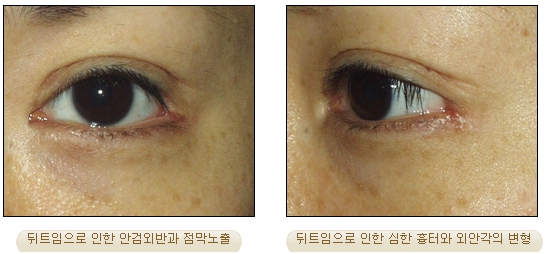 [Duhan Plastic Surgery Double Eyelid Revision] - [Inner Corner Revision, Outer Corner Revision] image 9