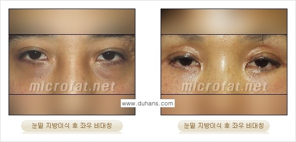 [두한성형외과 "미세지방이식"] - [지방이식 부작용 교정 정보 ①] 관련 이미지 7