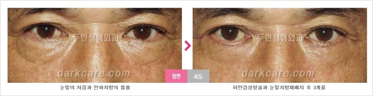 ​[두한성형외과 경쟁력 눈밑성형 리더] - [눈밑 다크써클의 증상, 원인, 종류, 치료방법 안내] 관련 이미지 52