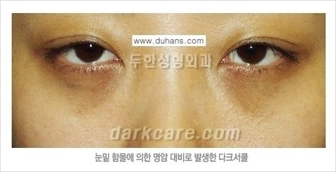 [두한성형외과 경쟁력 눈밑성형] - [다크써클의 원인과 다크써클의 종류] 관련 이미지 7