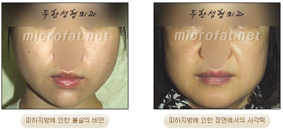 [Duhan Plastic Surgery Liposuction] - [Facial Liposuction] image 1