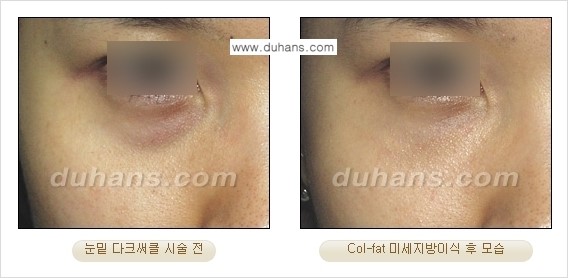 [두한성형외과 경쟁력 미세지방이식]-[Col-fat 입체지방이식 사례 안내] 관련 이미지 4