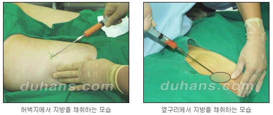 [두한성형외과 얼굴자가지방이식] - [지방이식 과정] 관련 이미지 12