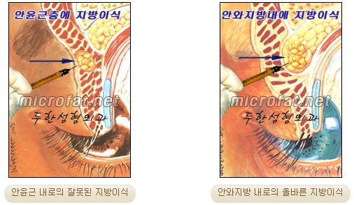[Doohan Plastic Surgery Autologous Fat Grafting] - [Sunken Eye Fat Grafting] image 5