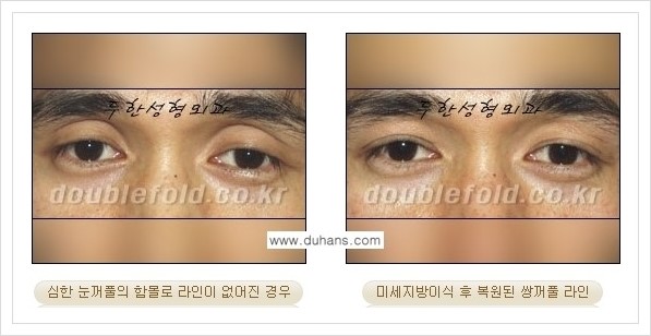 [두한성형외과 경쟁력 쌍꺼풀 재수술(극한 재수술)] - [라인이 풀렸을 경우의 쌍꺼풀 재수술 안내 ②] 관련 이미지 6