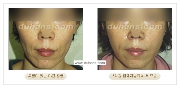 [두한성형외과 경쟁력 얼굴미세지방이식] - [볼살지방이식, 이마지방이식, 측두부지방이식 안내] 관련 이미지 7