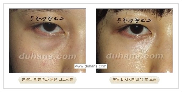 [두한성형외과 경쟁력 눈밑성형] - [꺼진 눈밑, 눈밑 함몰 주름선 눈밑 미세지방이식 안내] 관련 이미지 14